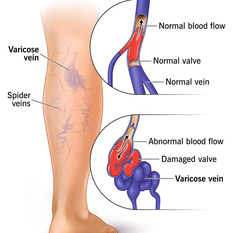 Varicose Veins Causes And Treatment