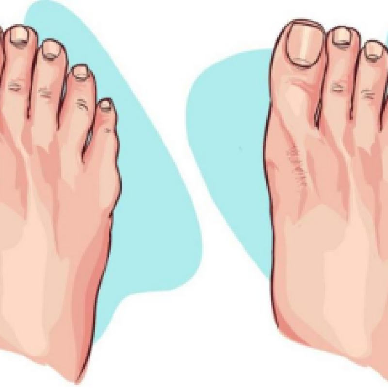 Understanding Gout: Causes, Symptoms, and Treatment