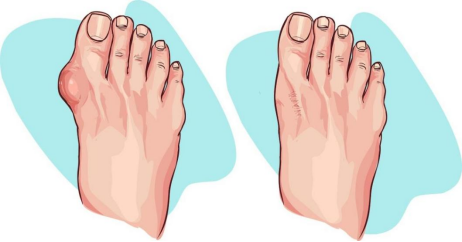 Understanding Gout: Causes, Symptoms, and Treatment