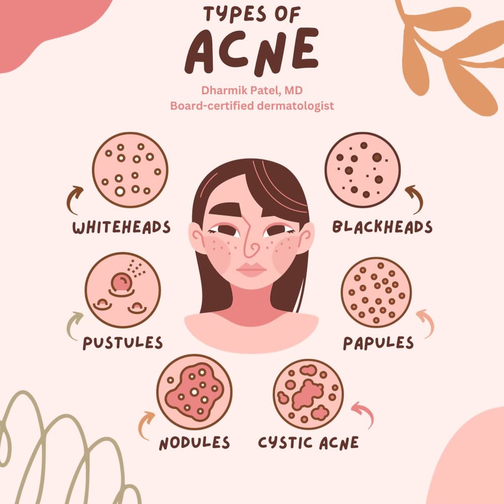 Types of Acne