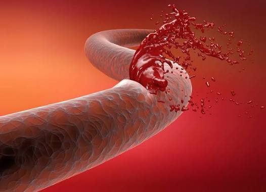 HEMOPHILIA