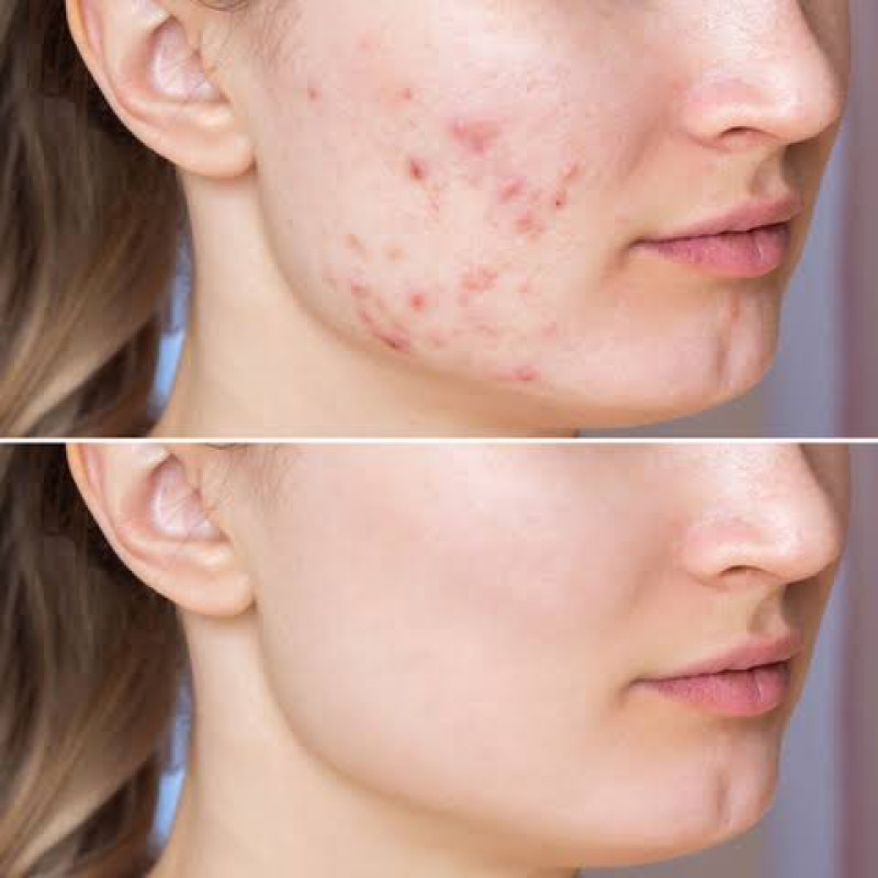 Acne & Treatment