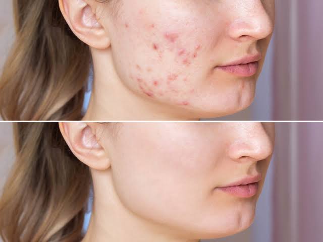 Acne & Treatment