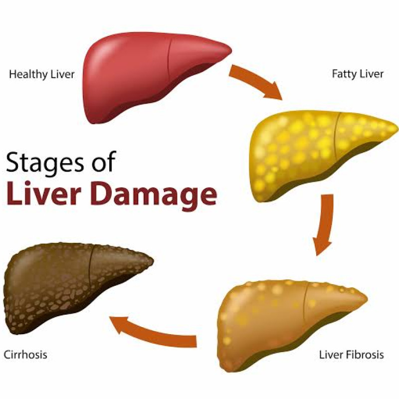 Fatty Liver